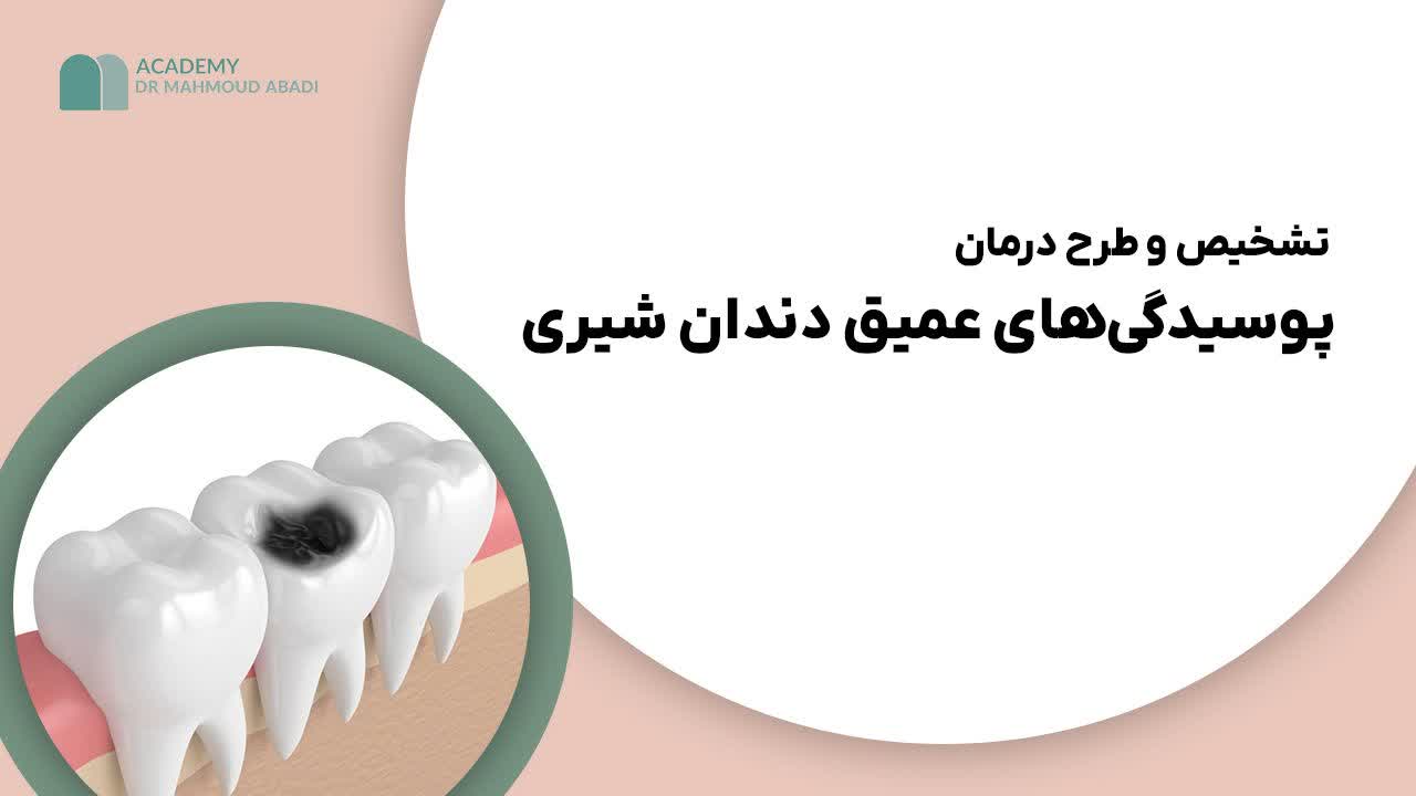 تشخیص و طرح درمان پوسیدگیهای عمیق