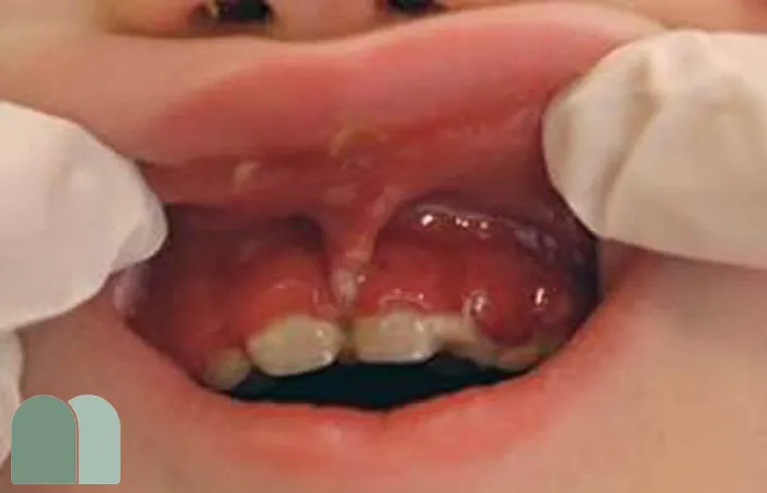 بیماری ژنژیواستوماتیت اولیه