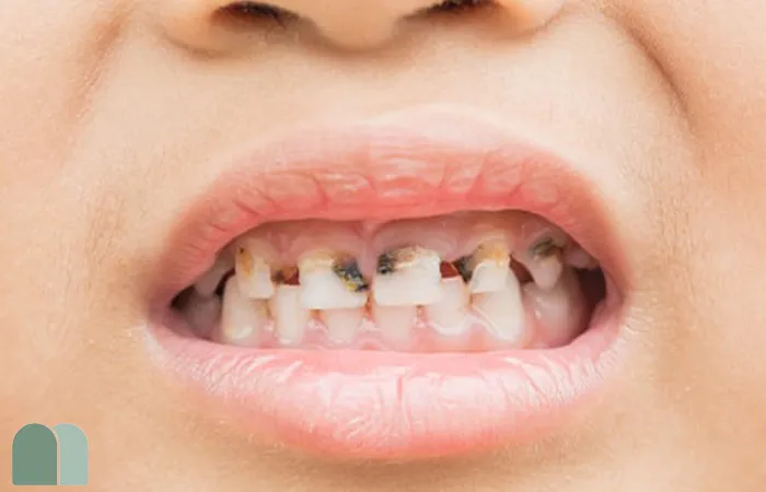 بهترین روش‌های درمان پوسیدگی‌های عمیق در دندان‌های شیری ،  دندانپزشکی مداخله حداقلی (MID) ، تکنیک هال ، پوشش غیرمستقیم پالپ (IPC) ، پولپوتومی ، فلوراید دی‌آمین نقره ، تکنیک ترمیم غیرتهاجمی (ART) ، ترمیم دندان‌های شیری ، تاج فلزی پیش‌ساخته (PMC) ، درمان پوسیدگی‌های دندان‌های شیری