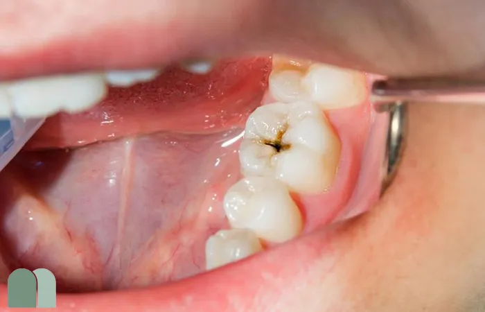 بهترین روش‌های درمان پوسیدگی‌های عمیق در دندان‌های شیری