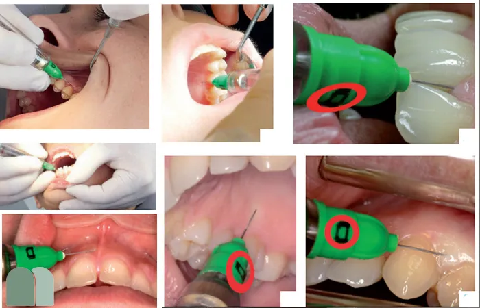 تزریق داخل استخوانی در دندانپزشکی کودکان ، فیلم تزریق داخل استخوانی ، تزریق داخل تزاشه ، سوزن داخل استخوانی ، تزریق استخوان دندانپزشکی