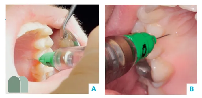 تزریق داخل استخوانی در دندانپزشکی کودکان