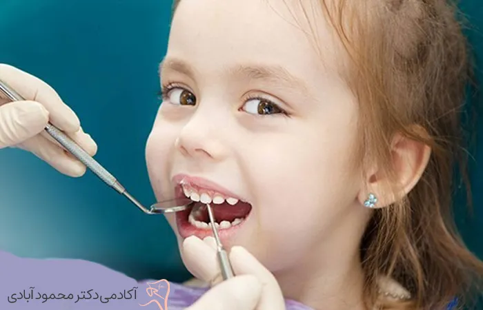درسیلور دی آمین فلوراید (SDF) در دندانپزشکی کودکان