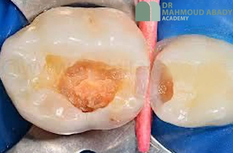 تفاوت تراش دندان شیری و دائمی 