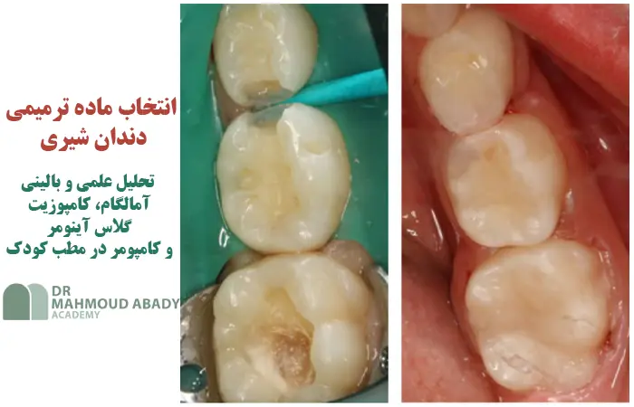  انتخاب ماده ترمیمی دندان شیری