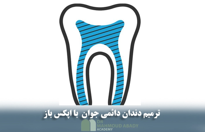 ترمیم دندان دائمی جوان با اپکس باز