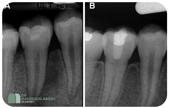 اپکسوژنزیس