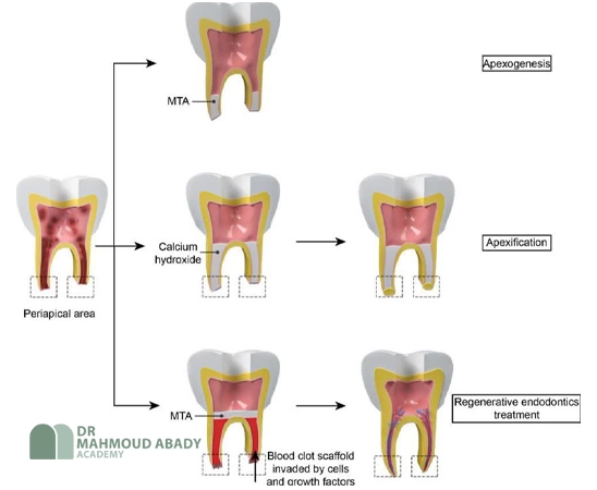 رمیم دندان دائمی جوان
