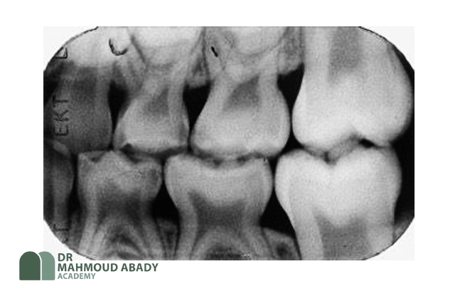 ماتریس دندانپزشکی اطفال