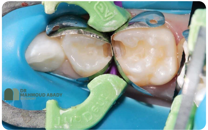 ترمیم کلاس II دندان شیری