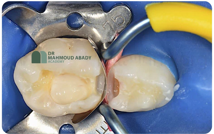 سیستم ماتریس سکشنال دندان شیری