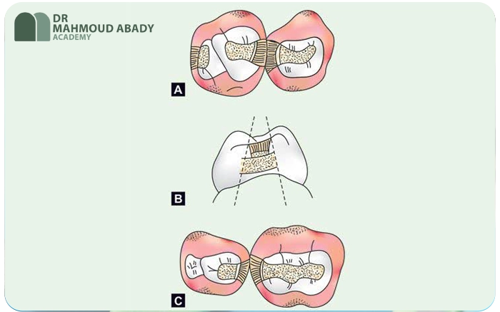 چالش‌های ترمیم دندان شیری