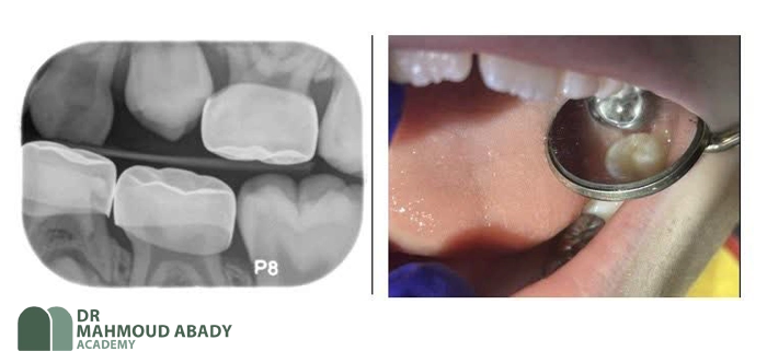 درمان پوسیدگی بدون تراش