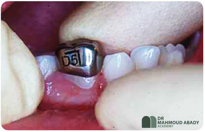 تکنیک هال ، روکش فلزی دندان شیری ، درمان پوسیدگی بدون تراش ، درمان بدون بی‌حسی، دندانپزشکی کم تهاجمی ، دندانپزشکی کودکان