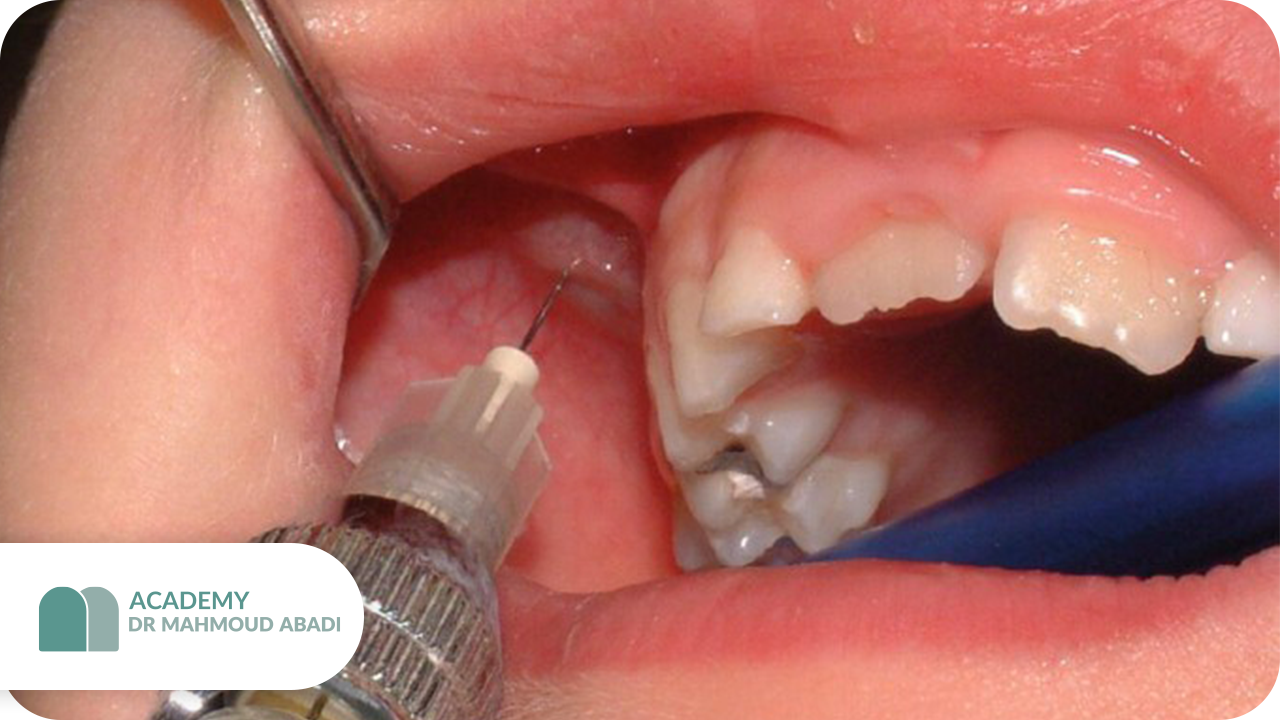 دوز لیدوکائین در اطفال