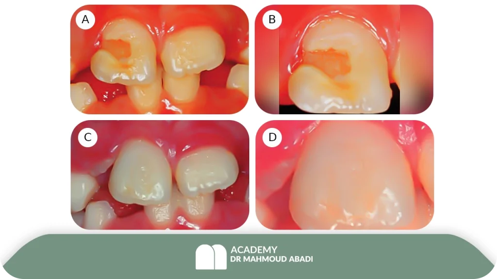 انواع آسیب‌های جوانه دندان دائمی پس از تروما به دندان شیری