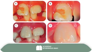 انواع آسیب‌های جوانه دندان دائمی پس از تروما به دندان شیری
